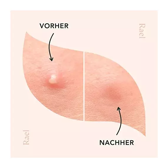 Rael Hydrokolloid Akne Pimple Patch – Unsichtbar, Makelfleck, Hydrokolloid, Hautbehandlung, zwei Grössen (96 count), 4 image