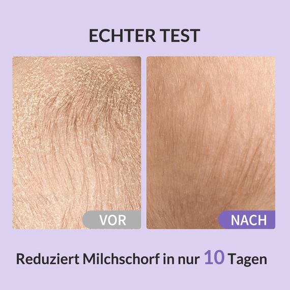 Bee Nature - Baby Shampoo Bio - Honig Mousse - Milchschorf Behandlung - Tränenfrei - Geeignet für Neugeborene, Kinder, Erwachsene mit Trockener, Empfindlicher, Ekzem, Juckende Kopfhaut- 400ml(2*200ml)