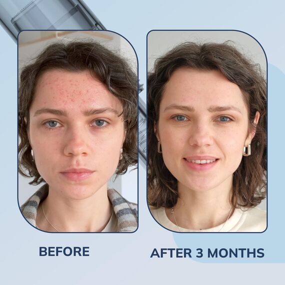 36 Pin Ersatz Derma Pen Mikronadel Microneedling Nadelpatronen für Auto Derma Micro Nadelroller Electric Pen, 10 Stück MEHRWEG semi-permanent