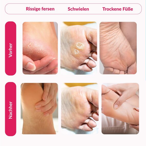 Summer Foot Premium Hornhaut-Entferner (2 Paare) - Hornhaut Fußmaske für weiche Füße - Anti Hornhaut-Socken für effektive Fußpflege - dermatologisch getestet