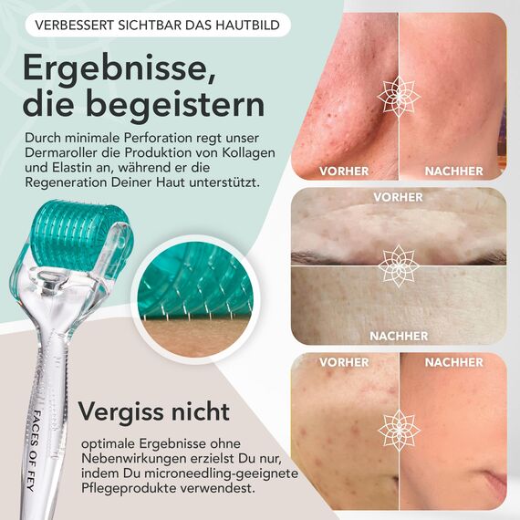 FACES OF FEY Derma Roller - 192 ECHTE NADELN- professionelles Microneedling zuhause - Nadelroller gegen Narben, Cellulite & Dehnungsstreifen - Microneedlingroller 0,75mm
