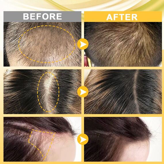 Beayosses Dermaroller Set 0.5mm Microneedling Hautroller mit Haar Wachstum Serum, Anti-Haarausfall, 30ML , Haarausfall und Haar-Behandlung