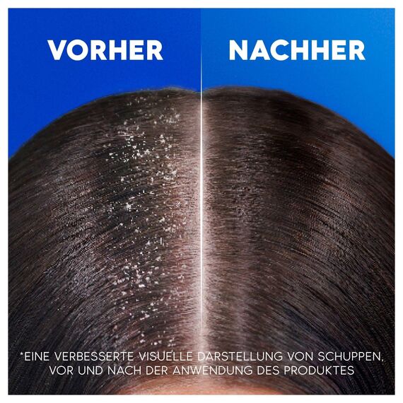 Head & Shoulders Juckende Kopfhaut Anti-Schuppen-Shampoo 500ml, zur Täglichen Anwendung, Bis zu 100 Prozent Schuppenschutz, Klinisch Getestet