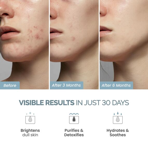 Dead Sea Mud Mask for Face Care - Body Mud Mask with Hyaluronsäure for Women and Men - Pore Minimizer Skin Care - Teep Cleansing Skin Purifying Face Mask for Mitesser, Oily Skin - 8.1oz/240g