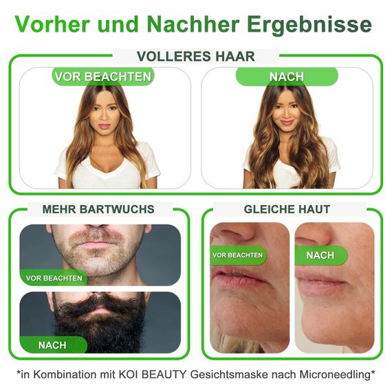 KOI BEAUTY Einstellbar Microneedling Derma Stamp, Professioneller Microneedling Pen mit 140 ECHTE NADELN Titan, DermaPen für Haare, Bartwuchs, Gesicht, Körper, Beste Derma roller Alternative