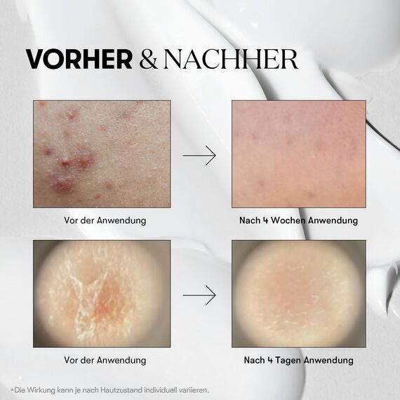 VT COSMETICS CICA Reedle Shot 700, Spicule Mikronadel-Serum für Porenpflege & Peeling, Exosom & Centella Asiatica für Glas-Haut, Akne- & Unreinheitenpflege (1 Fl Oz / 30ml)