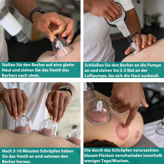 24 Stück Schröpfgläser mit Vakuumpumpe, Schröpfglas für Gesicht und Körper, Schröpfen zur Gegen Cellulite, Spannung und Entspannen Muskeln, Schröpfset mit Akupressurpunkt Magneten