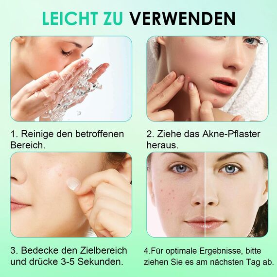 Home Holic Pimple Patches Hydrokolloid Unsichtbare 264 Stück Pickel Patch mit Teebaumöl Tag und Nacht Verwenden Pimple Patch Akne Patches Wasserdichte Atmungsaktive Acne Pflaster Anti