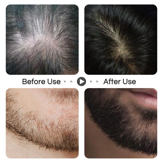 Dr.roller Bartroller Bartwuchs Set, Derma Roller 0,5mm und Bartöl-Serum Stimuliert Bart Haarwuchs, Microneedling Bart Derma Roller für Haare Kopfhaut Gesicht Körper - Männer & Frauen