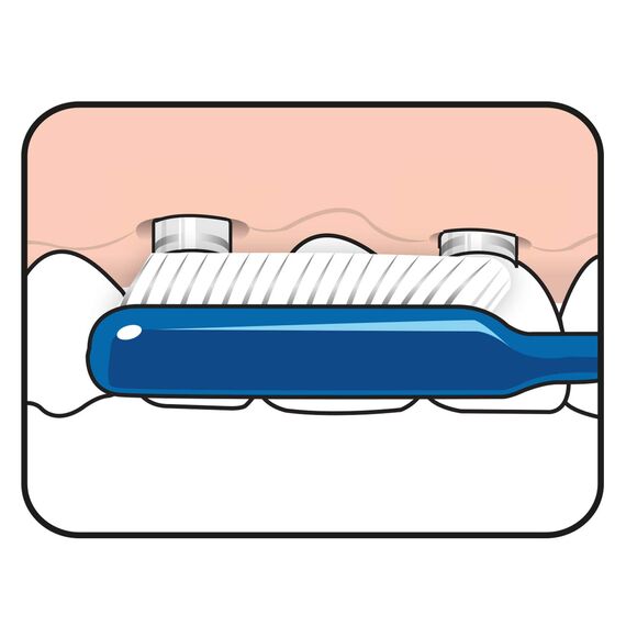 TEPE Spezial-Zahnbürste Implantat Orthodontic mit extra schmalem Bürstenkopf - für Zahnspangen & zur Implantat Reinigung hergestellt / 1 x 1 Stück, Farblich sortiert, 1stk (Packung mit 2)