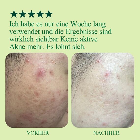 [PKY] Pyunkang Yul Ultimative Beruhigungslösungscreme für empfindliche Haut mit patentierten Inhaltsstoffen, Feuchtigkeitscreme beruhigt und lindert Rötungen intensiv mit Cica & Teebaum 30ml