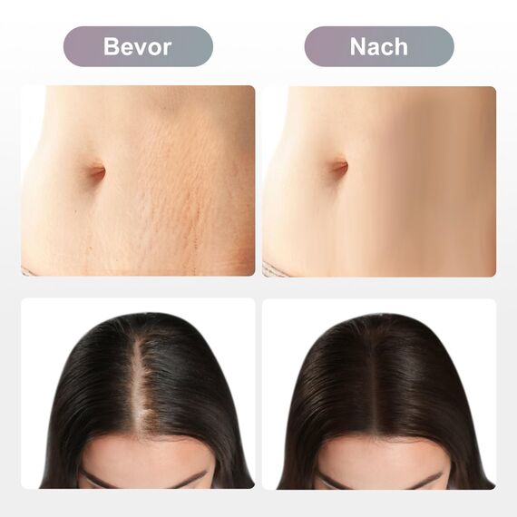 Dr. pen Ultima M8/M7S Cartridges 11 Pins - 10 Stück für Aknenarben, Vertiefungen, Narben und Streifen - Authentische Dr pen Ultima M8/M7S Patronen(10 Stück, 11 Pins für M8/M7S)