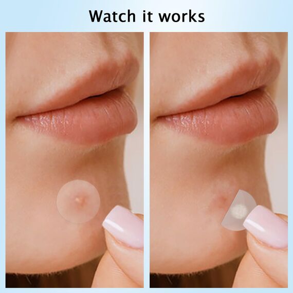 360 Stück Pickel Patch Hydrokolloid Acne Pimple Patches Anti-Akne Patch Unsichtbare für Tag & Nacht mit Teebaumöl, Salicylsäure,Centella Asiatica｜4 Größen 8 mm,10 mm,12 mm,14 mm