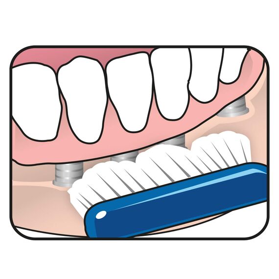 TEPE Spezial-Zahnbürste Implantat Orthodontic mit extra schmalem Bürstenkopf - für Zahnspangen & zur Implantat Reinigung hergestellt / 1 x 1 Stück, Farblich sortiert, 1stk (Packung mit 3)