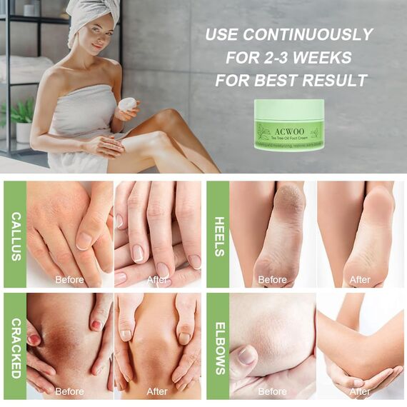 ACWOO Fußcreme, Beruhigende Feuchtigkeitsspendende Creme für Füße, Hornhautentferner Fußcreme,Teebaum und Aloe Vera für tiefe Feuchtigkeit für sehr trockene und raue Haut Füße, Hände