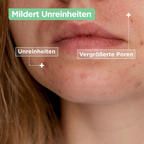 Mixa Anti-Unreinheiten Comfort Cleanser, Für zu Akne neigende und sensible Haut, Glättet das Erscheinungsbild der Poren, Mit Salicylsäure und Squalan, Geeignet für Gesicht & Hals, Hypoallergen, 150 ml