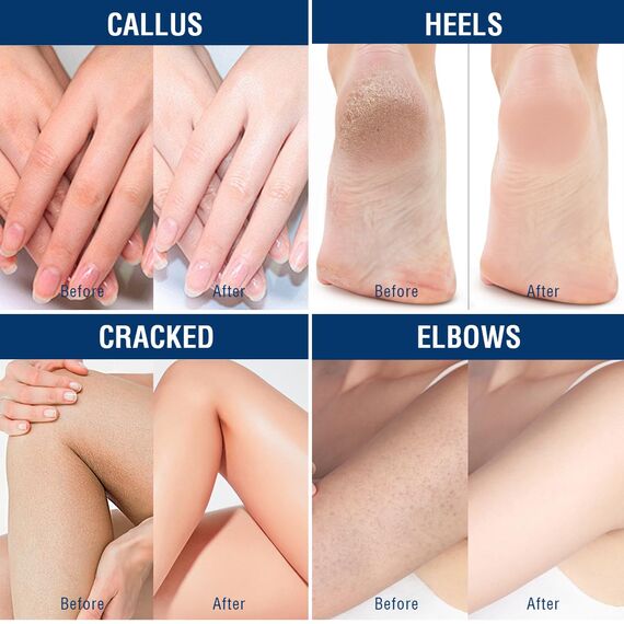 OUKEYA Urea-Creme 40 Prozent für Fuß und Hände, Urea Cream Fuß, Fußcreme, Harnstoffcreme für Trockene, Rissige Füße, Anti Hornhaut, Lotion für Fersen, Ellenbogen, Maximaler Stärke, 350g