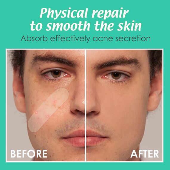 Pimple Patches Hydrokolloid Unsichtbare Pickel Patch mit Teebaumöl Tag und Nacht Verwenden Pimple Patch Akne Patches Wasserdichte Atmungsaktive Acne Patch Pflaster (40 Stück, Streifen)