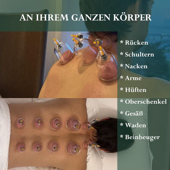 Uplife Schröpfgläser mit Vakuumpumpe - Schröpfset mit 12 Gläsern für Schröpfen & Cupping Therapie - Schröpfgerät & Massage Set Physiotherapie Zubehör - Cupping Set