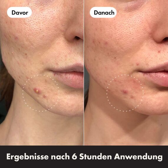 Hero Cosmetics Mighty Patch Day + Night, Hydrocolloid-Aknepflaster, ziehen Unreinheiten in 6 Stunden aus Pickeln, Tag- & Nachtbehandlung, 24 Pickel-Patches: 12 für den Tag & 12 für die Nacht.