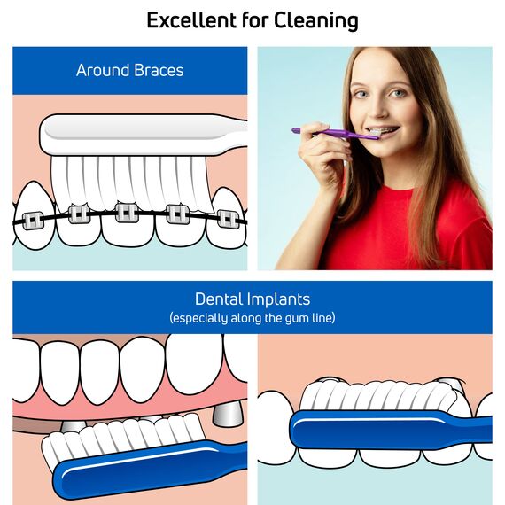 TePe Implantat- und Kieferorthopädische Zahnbürste, 2er Pack, 2 Stück, Mittel, Nylon, Kunststoff, Manuell, Unisex-Erwachsene, Erwachsene, Zufällige Farbe, Einweg