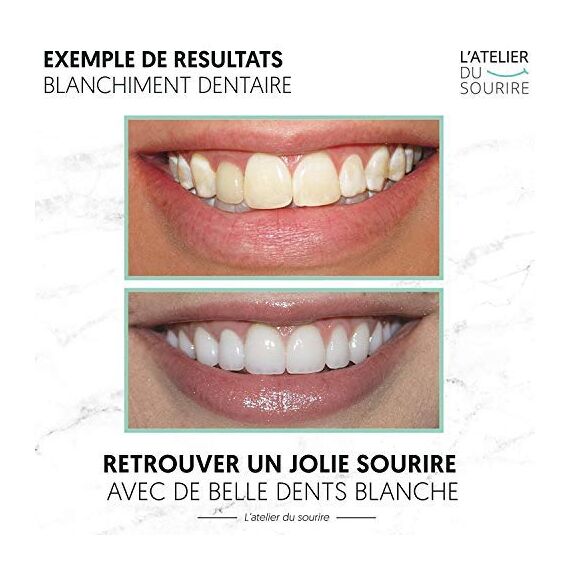 Professionelles zahnaufhellung kit L'ATELIER DU SOURIRE ® - Komplettes Kit für 10 zahnbleaching zu Hause (Erdbeere)