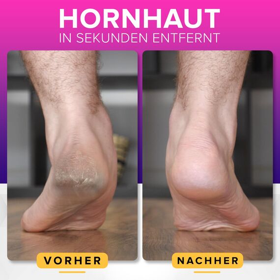 ULTIMATIVE Hornhautfeile Hornhautentferner Für Fußpflege (Groß) MEGAFILE Hornhauthobel Für Hornhaut Entfernen Fuß - Hornhautraspel Für Hornhautentferner Starke Hornhaut Tote Haut Fuß Schaber