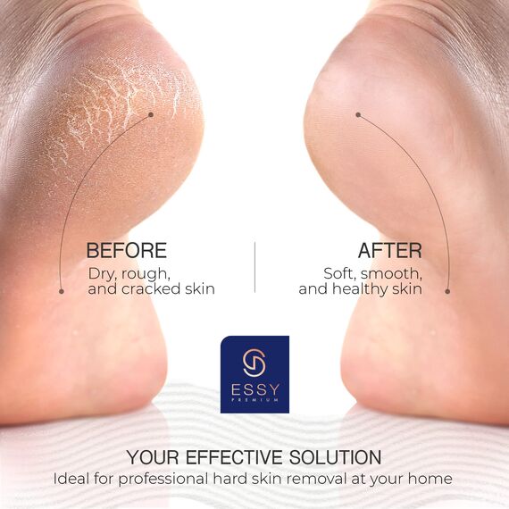 Essy Hornhautentferner Elektrisch mit 5 Ersatzrollen Hornhaut Entfernen Fuß Elektrischer Hornhautentferner Elektrisch Testsieger Elektrische Hornhautentfernung Hornhaut Pediküre Set Fußpflege (Blau)