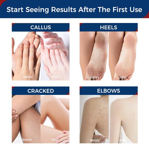 OUKEYA Urea Creme 42% mit 2% Salicylsäure, Fusscreme Feuchtigkeit & Reparatur für Trockene, Füße, Fersen, Knie, Urea Handcreme für Hände, Fußcreme, Hornhautentferner, Tote Haut, 2 x 85g