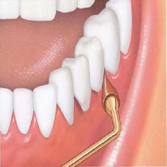 G-u-m Stimulator Refills, 3 Ea