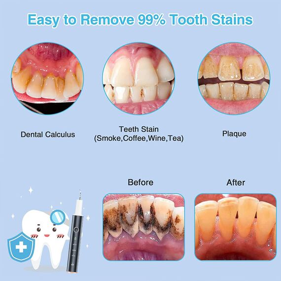 Zahnsteinentferner Zahnreinigung IPX7 Asserdicht mit 4 Modi und 4 Düsen Tragbare Elektrische Munddusche von Speiseresten und Reinigen Zahnbürste der Zähne USB-C Wiederaufladbar